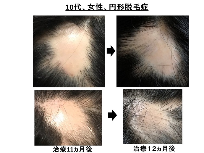 円形脱毛症　病院